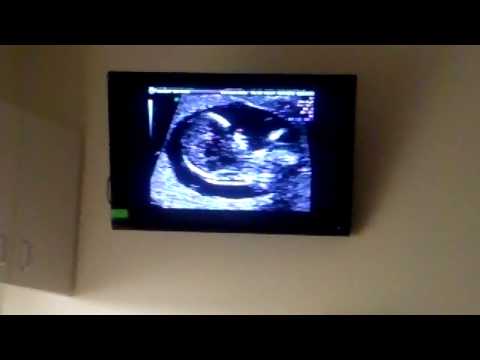 how to measure nt in ultrasound
