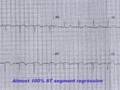 Heparin . . . The forgotten hero in  myocardial infarction