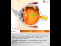 Glaucome 3D: Quantel Medical