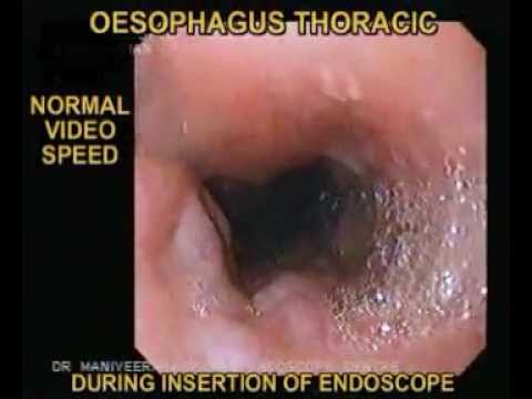 how to cure esophageal varices