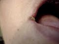 Oral Herpes Simplex ... Cold Sore #04  Cold Sore Herpes Simplex