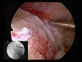 Hip Arthroscopy with Femoral Neck Resection Part II