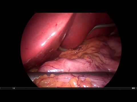 Tüp mide ameliyatı nasıl yapılır? Prof Dr Koray Tekin (Sleeve Gastrectomy)