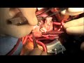 Aortic Stenosis - Ross Konno Procedure with Aortic Arch Reconstruction - Pediatric Heart Surgery