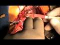 Aortic Stenosis - Ross Konno Procedure with Aortic Arch Reconstruction - Pediatric Heart Surgery