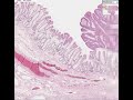 Histopathology Colon--Tubular adenoma (adenomatous polyp) Histopathology Colon--Tubular adenoma (adenomatous polyp)