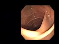 Melanosis coli Melanosis coli