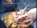 Revision knee replacement surgery part 2
