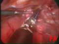Pneumotorace (PNX, pneumothorax) spontaneo primitivo, VATS. Pneumotorace (PNX, pneumothorax) spontaneo primitivo, VATS.
