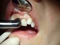 Waterlase MD Laser Gingivectomy Part 1