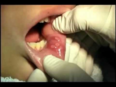how to cure aftas