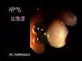 http://www.officialhealthtips.com

Video Hemorrhoids rubber band ligation 3

Other hemorrhoids surgery types:
hemorrhoidectomy, laser coagulation, infrared photocoagulation, injection sclerotherapy, rubber band ligation, doppler Guided Hemorrhoid Artery Ligation


http://www.officialhealthtips.com