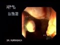 Video Hemorrhoids rubber band ligation 3