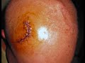 Cerebral Endoscopy guided by Panacea Neuronavigator