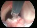 Cerebral Endoscopy guided by Panacea Neuronavigator