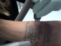 Tattoo Removal - Forearm Tattoo
