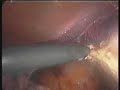 Manipuseal Balloon Hysterectomy
