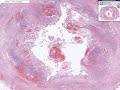 Histopathology Acute Appendicitis Histopathology Acute Appendicitis