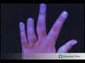 Juvenile Arthritis report a case study