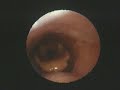 Expiratory Vocal Cord Dysfunction and Laryngopharyngeal Reflux Expiratory Vocal Cord Dysfunction and Laryngopharyngeal Reflux
