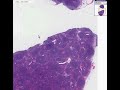 Histopathology Lymph node--Mantle cell lymphoma
