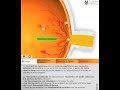 Rétinopathie diabétique 3D: Quantel medical