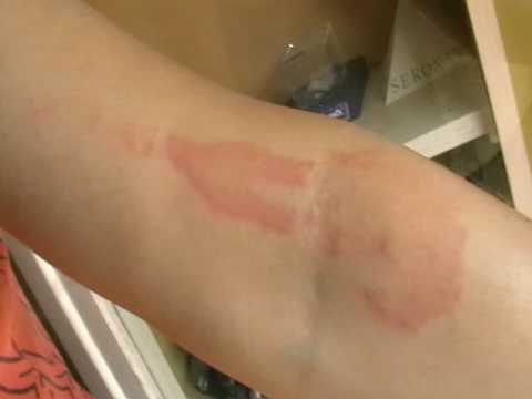 how to treat an allergic reaction to ky jelly