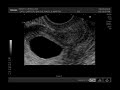 Sonogram 7 weeks 4 days
