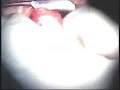 pterygium resection autograft surgery by Isao Otaka M.D.