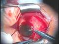 pterygium resection autograft surgery pterygium resection autograft surgery