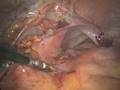 LIve Webcast: Advances in Colorectal Cancer Therapies