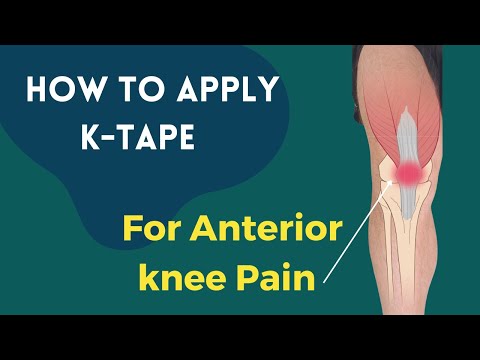 how to treat patellofemoral pain syndrome pfps