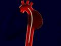 Podcast: Minimally Invasive Treatment For Thoracic Aortic...
