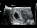 Baby Williams' 1st Ultrasound