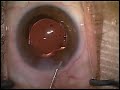 cataract surgery crystalens lens implant by Uday Devgan MD cataract surgery crystalens lens implant by Uday Devgan MD