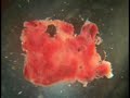 new news Scary Morgellons disease everyone must see