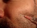 Body-hair-transplant-face