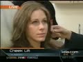 cheek-lift-with-radiesse.html