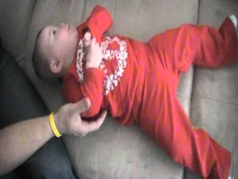 Infantile Spasms (Aicardi Syndrome)