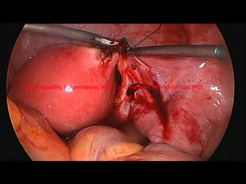 Ectopic pregnancy after IVF. Laparoscopic surgery I