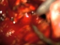 Hemorrage Stopping With Adenosine In Aneurysm Removal Hemorrage Stopping With Adenosine In Aneurysm Removal