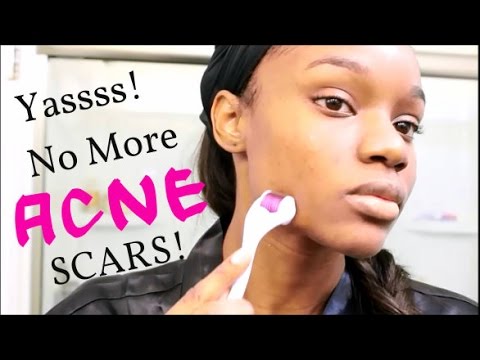 how to banish acne scars