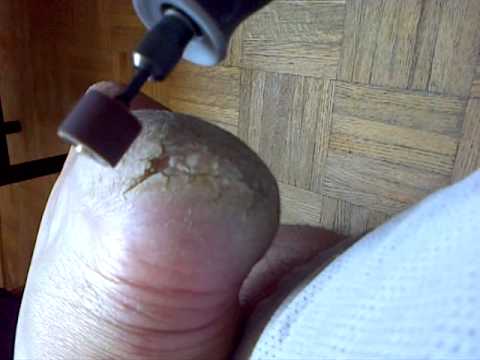 how to cure cracked feet