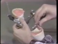 Correction of the Occlusion After Processing