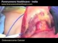Osteosarcoma treatment in India is...