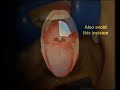 How To Remove A Tumor On The Palate (Torus Palatinus)
