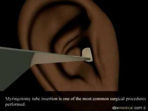 how to unclog tympanostomy tubes