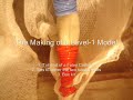 LAPAROSCOPIC PROSTATESTOMY DORSAL VEIN COMPLEX LIGATION USING THE KOMMU 'LEVELS OF MODELS'. THIS IS A SHORTENED VERSION