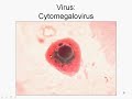 Opportunistic Infections Opportunistic Infections
