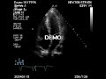 Echocardiogram - Overview